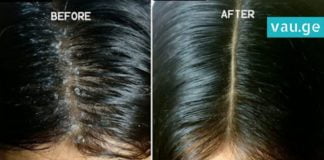 ქერტლის საწინააღმდეგო სასწაულმოქმედი საშუალება. საიდუმლო მხოლოდ 1 ინგრედიენტშია