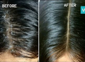 ქერტლის საწინააღმდეგო სასწაულმოქმედი საშუალება. საიდუმლო მხოლოდ 1 ინგრედიენტშია