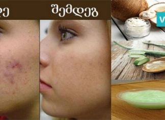აკნესგან გათავისუფლების საუკეთესო ხერხი. ეს თქვენს კანს უფრო რბილს და გლუვს გახდის