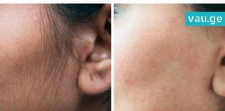 როგორ უნდა მოიშოროთ სახიდან არასასურველი თმა? ბევრჯერ ნაცადი და ეფექტური მეთოდი