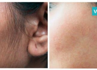 როგორ უნდა მოიშოროთ სახიდან არასასურველი თმა? ბევრჯერ ნაცადი და ეფექტური მეთოდი