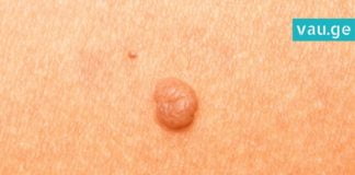 ამ ერთი ნატურალური ინგრედიენტის გამოყენებით, მეჭეჭებისგან სამუდამოდ გათავისუფლდებით !