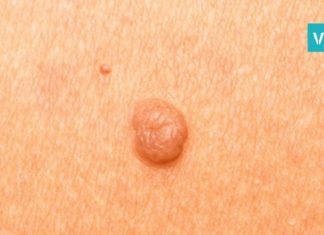 ამ ერთი ნატურალური ინგრედიენტის გამოყენებით, მეჭეჭებისგან სამუდამოდ გათავისუფლდებით !