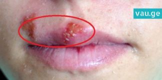 ჰერპესის ვირუსი – ის, რაც კანის უბრალო გაღიზიანება გქონიათ ბევრად საშიშია
