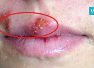 ჰერპესის ვირუსი – ის, რაც კანის უბრალო გაღიზიანება გქონიათ ბევრად საშიშია