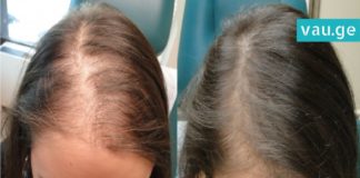 ამ ნატურალური რეცეპტის გამოყენებით თმა ორჯერ უფრო სწრაფად გაგეზრდებათ