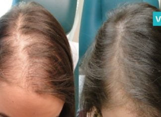 ამ ნატურალური რეცეპტის გამოყენებით თმა ორჯერ უფრო სწრაფად გაგეზრდებათ