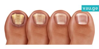 მხოლოდ და მხოლოდ 2 ინგრედიენტი, რომელიც ფეხის სოკოსგან გაგათავისუფლებთ!