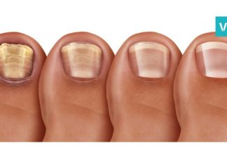 მხოლოდ და მხოლოდ 2 ინგრედიენტი, რომელიც ფეხის სოკოსგან გაგათავისუფლებთ!