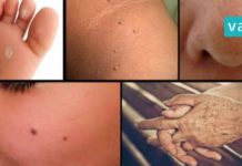 ასე ხალებს, მეჭეჭებს, ფერიმჭამელებსა და პიგმენტურ ლაქებს ნატურალური გზით მოიშორებთ