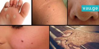 ასე ხალებს, მეჭეჭებს, ფერიმჭამელებსა და პიგმენტურ ლაქებს ნატურალური გზით მოიშორებთ