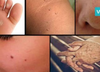 ასე ხალებს, მეჭეჭებს, ფერიმჭამელებსა და პიგმენტურ ლაქებს ნატურალური გზით მოიშორებთ