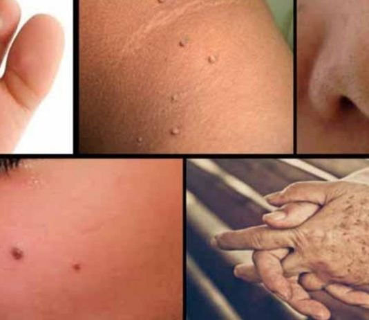 ასე ხალებს, მეჭეჭებს, ფერიმჭამელებსა და პიგმენტურ ლაქებს ნატურალური გზით მოიშორებთ