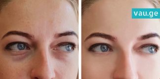 წაისვით ეს მიქსტურა ჩაშავებულ უპეებზე და სამუდამოდ დაივიწყეთ ისინი! შედეგი გარანტირებულია!