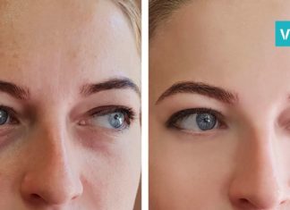 წაისვით ეს მიქსტურა ჩაშავებულ უპეებზე და სამუდამოდ დაივიწყეთ ისინი! შედეგი გარანტირებულია!