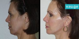 როგორ უნდა მოიშოროთ ღაბაბი? ყველაზე მარტივი და ეფექტური ხერხი რაც აქამდე გსმენიათ