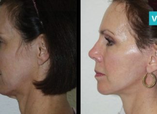 როგორ უნდა მოიშოროთ ღაბაბი? ყველაზე მარტივი და ეფექტური ხერხი რაც აქამდე გსმენიათ