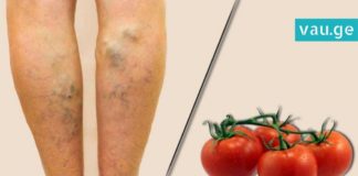 უმკურნალეთ ვენების ვარიკოზულ გაგანიერებას პომიდვრის დახმარებით
