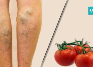 უმკურნალეთ ვენების ვარიკოზულ გაგანიერებას პომიდვრის დახმარებით