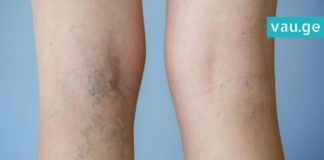 როგორ უნდა მოიქცეთ, რომ ფეხებზე ვენები არ შეგეტყოთ? ყველაზე ეფექტური რეცეპტია