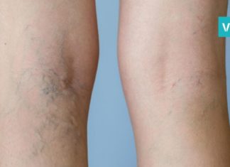 როგორ უნდა მოიქცეთ, რომ ფეხებზე ვენები არ შეგეტყოთ? ყველაზე ეფექტური რეცეპტია