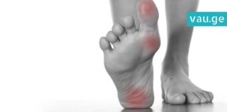 როგორ ვუმკურნალოთ კოჟრებს? 4 ყველაზე ეფექტური ხერხი, რომელიც კანს სწრაფად არბილებს