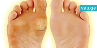 გათავისუფლდით კოჟრისა და მაზოლისგან სწრაფად და უმტკივნეულოდ!