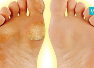 გათავისუფლდით კოჟრისა და მაზოლისგან სწრაფად და უმტკივნეულოდ!