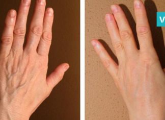 ეს სუპერმაზი თქვენს ხელებს გაახალგაზრდავებს! ეფექტური საშუალებაა…