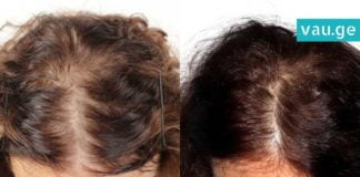 როგორ გავიზარდოთ თმა სწრაფად? ყველაზე ეფექტური და მარტივი მეთოდი!