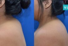 გაქვთ ცხიმგროვები კისერზე? ამ პროცედურის დახმარებით ლამაზ კისერს დაიბრუნებთ!