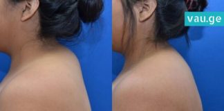 გაქვთ ცხიმგროვები კისერზე? ამ პროცედურის დახმარებით ლამაზ კისერს დაიბრუნებთ!