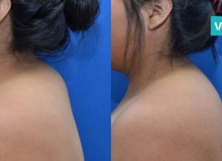 გაქვთ ცხიმგროვები კისერზე?  ამ პროცედურის დახმარებით ლამაზ კისერს დაიბრუნებთ!