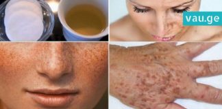 მოიშორეთ ნაოჭები, ჭორფლი და პიგმენტური ლაქები ამ საოცარი ლოსიონის დახარებით! ნახეთ რეცეპტი…