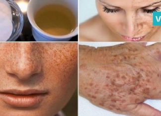 მოიშორეთ ნაოჭები, ჭორფლი და პიგმენტური ლაქები ამ საოცარი ლოსიონის დახარებით! ნახეთ რეცეპტი…