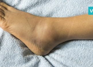 ეს ყველაზე ძლიერი ბუნებრივი საშუალებაა ფეხების შეშუპების წინააღმდეგ!