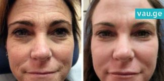 ეფექტური საშუალება ნაოჭების წინააღმდეგ– თქვენ მხოლოდ 2 ინგრედიენტი დაგჭირდებათ!