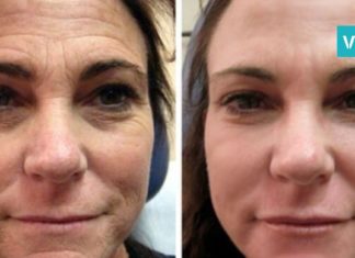 ეფექტური საშუალება ნაოჭების წინააღმდეგ– თქვენ მხოლოდ 2 ინგრედიენტი დაგჭირდებათ!