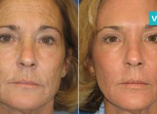 სილამაზის თურქული რეცეპტი-ნაოჭებთან საბრძოლველი ეფექტური საშუალება!