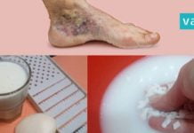 მოიშუშეთ ვენების გაფართოებისგან მოყენებული ტკივილი ამ ინგრედიენტის დახმარებით!