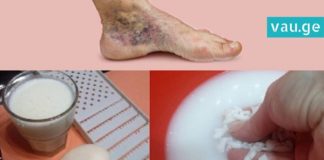 მოიშუშეთ ვენების გაფართოებისგან მოყენებული ტკივილი ამ ინგრედიენტის დახმარებით!