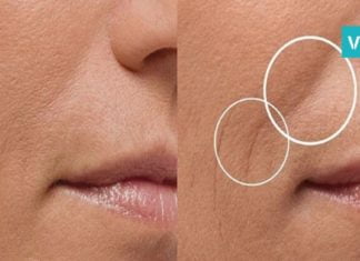 როგორ უნდა მოიშოროთ სახიდან ეს ხაზები? საუკეთესო საშუალებაა