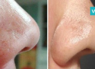 მოიშორეთ შავი წერტილები უმარტივესად-ეფექტური მეთოდი თქვენთვის!