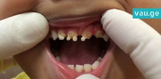 თქვენ გაგიჟდებით, როცა გაიგებთ, თუ რამ გამოიწვია ამ ბავშვის კბილების დაზიანება! მშობლებო, ყურადსაღებია!