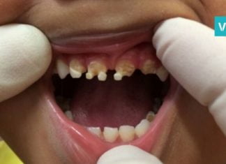 თქვენ გაგიჟდებით, როცა გაიგებთ, თუ რამ გამოიწვია ამ ბავშვის კბილების დაზიანება! მშობლებო, ყურადსაღებია!