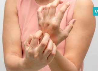 აი, რა უნდა იცოდეთ ფსორიაზზე-სასარგებლო რჩევები თქვენთვის!