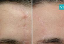 მოიშორეთ შრამები და ნაწიბურები ხალხური მეთოდის გამოყენებით-ეფექტურია!