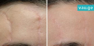 მოიშორეთ შრამები და ნაწიბურები ხალხური მეთოდის გამოყენებით-ეფექტურია!