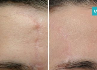 მოიშორეთ შრამები და ნაწიბურები ხალხური მეთოდის გამოყენებით-ეფექტურია!