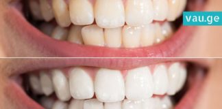 ნადები კბილებიდან 5 წუთში გაქრება-ეფექტური მეთოდი თქვენთვის!